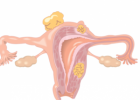 恶性子宫肌瘤的治疗方案 恶性子宫肌瘤有什么危害