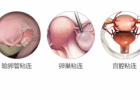 宫腔粘连会导致不孕吗 宫腔粘连的临床表现