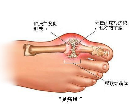 大母脚趾痛风如何治疗好？