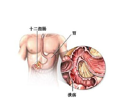 十二脂肠溃疡的症状