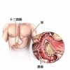 十二脂肠溃疡的症状