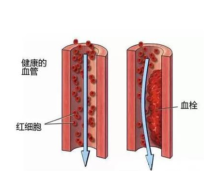 预防脑血栓方法 谨记血栓疾病6个红色信号