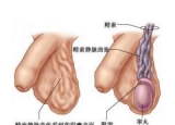 睾丸静脉曲张疾病