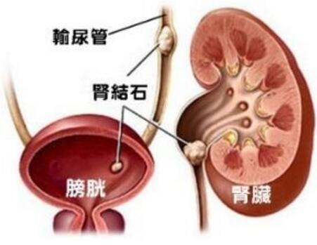 肾结石分类以及它的症状特征