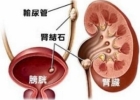 肾结石分类以及它的症状特征