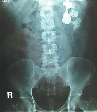 男子经常腹胀痛 去医院后从肾里取出143块结石
