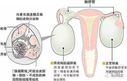 女子“怀孕”17年取出15斤重肿瘤 有头发和牙了