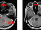孕妇颅内长巨大肿瘤 军医紧急剖宫产后再切肿瘤
