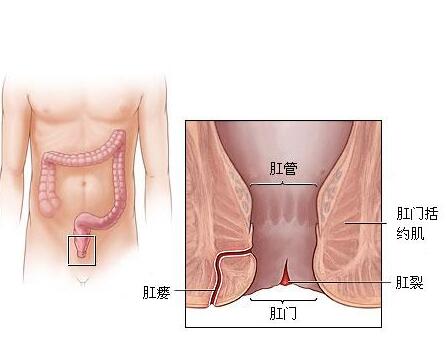 造成肛裂原因 发生肛裂如何治疗