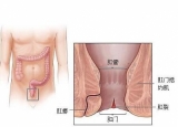 造成肛裂原因 发生肛裂如何治疗