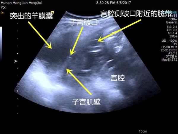 孕检时宝宝双脚踢出子宫 急救1小时母女脱险