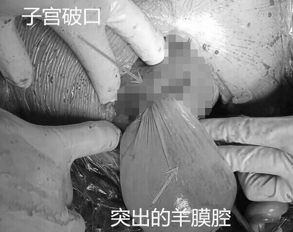 孕检时宝宝双脚踢出子宫 急救1小时母女脱险