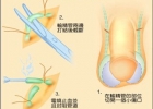 结扎后变太监？剖析男人结扎全过程